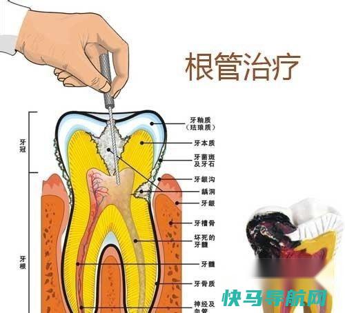 什么是根管，根管治疗的过程？