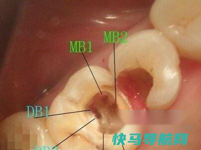什么是根管，根管的过程？ 第4张